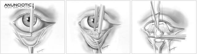 Blefaroplastia