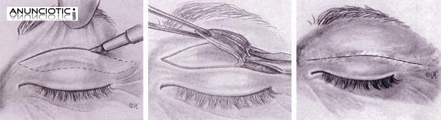 Blefaroplastia