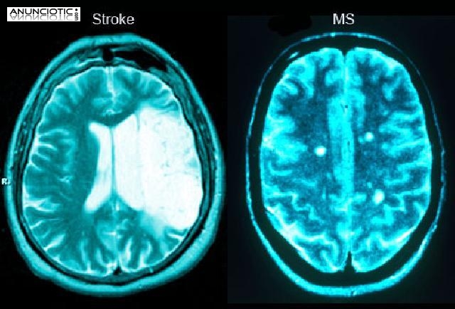 Tratamiento físico y cognitivo en casa. Fisioterapia